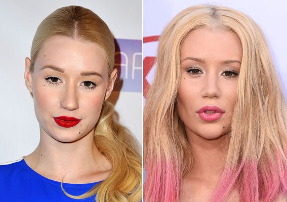 Stars Surgery Secrets Has Iggy Azalea Had Nose Job And Chin